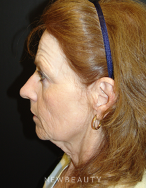 Dr. Mokhtar Asaadi Eyelid Lift, Facelift, Necklift - Before