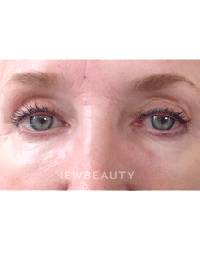 Dr. Julie Russak - Skin Tightner - After