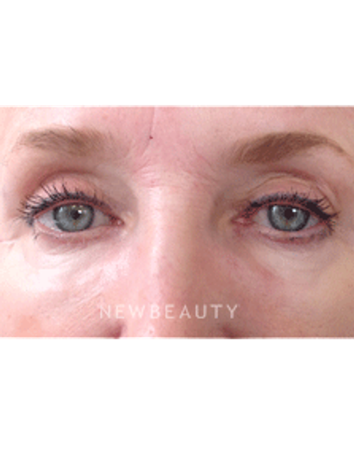 Dr. Julie Russak - Skin Tightner - After