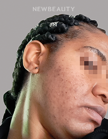 Dr. Anna Chacon - Acne - 34284242 - After