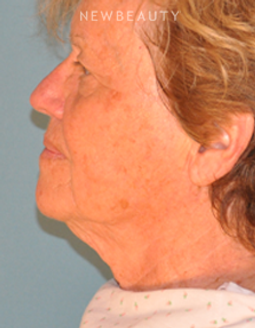 Dr. Alan Durkin - Limited Incision Facelift - Before