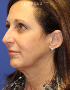 Dr. Dilip Madnani - Facelift - Before