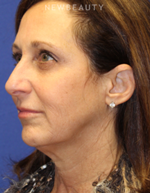 Dr. Dilip Madnani - Facelift - Before