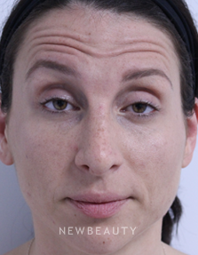Dr. Julie Russak - Botox - Before