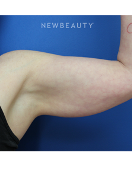 Dr. Joseph Russo - Arm Liposuction - Before