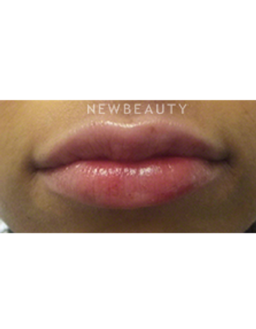 Dr. Kally Papantoniou - Volumizing Lips - After