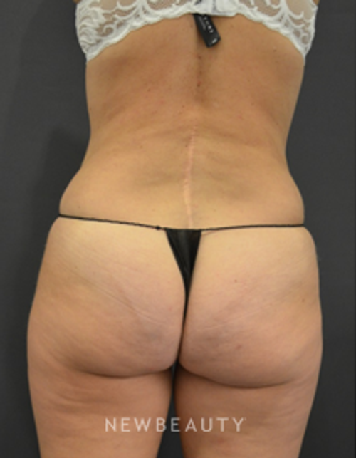 Dr. B. Aviva Preminger - Beautiful Contour - After