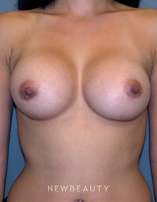 Dr Sean Simon Breast Augmentation - After