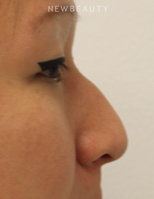 Dr. Kimberly Lee - Non-Surgical Rhinoplasty - Before