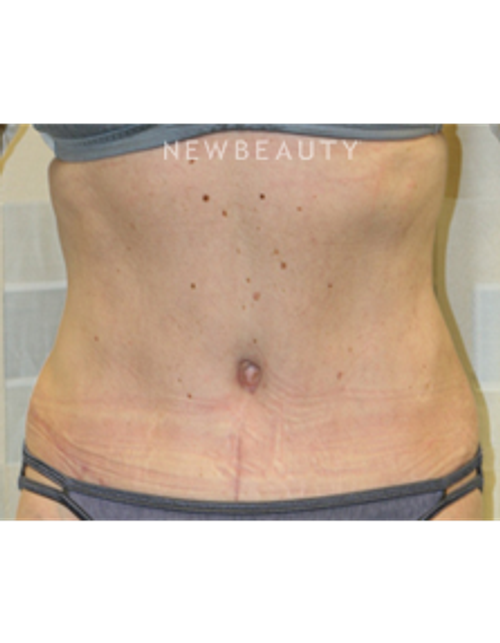 Dr. Christine Hamori - Tummy Tuck - After