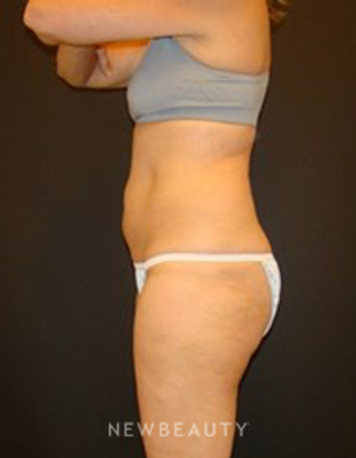 Dr. Joel Schlessinger - Coolsculpting - Before