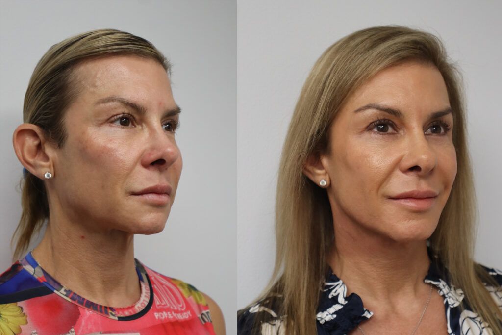 Janine's before and after images show the tumor along her jawline that was removed during her facelift and necklift surgery.