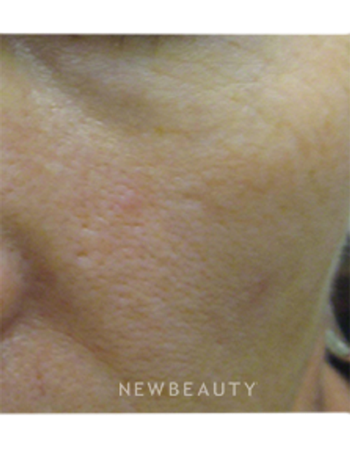Dr. Kally Papantoniou - Laser Resurfacing - After