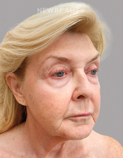 Dr. Daniel Schlessinger – Injectables And Fillers and Lasers – 53105363 - After