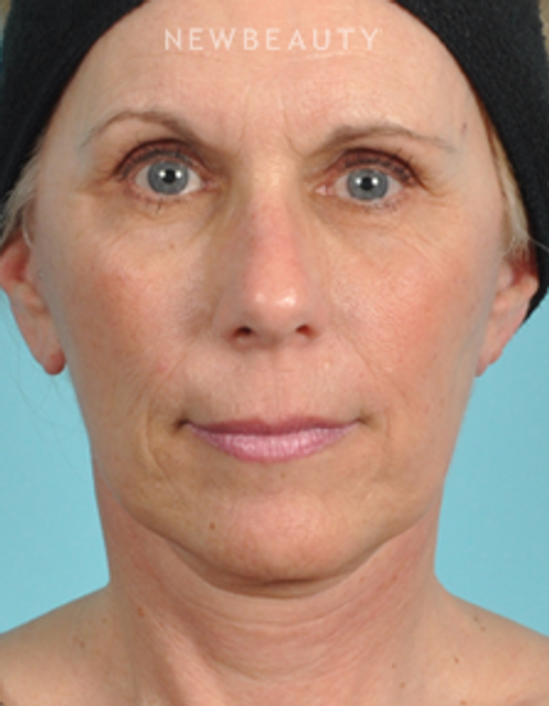 Dr. Bradley Bengtson - Facelift - After
