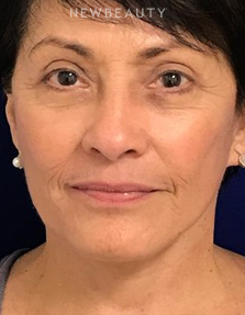 Dr. Dilip Madnani - Facelift - 13691970 - After