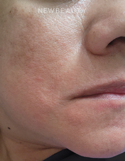 Dr. Anna Chacon - Melasma - 34291235 - After