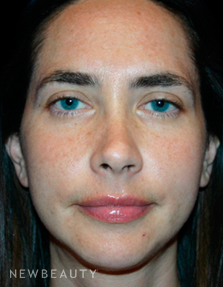 Dr. Kelly Bomer Photofacial - Before