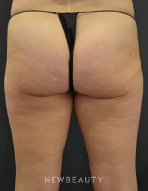 Dr. Aviva Preminger - CoolSculpting - After