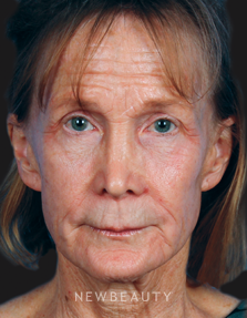 Dr. Kelly Bomer Liquid Lift, Lip Filler, Chemical Peel, Injectables & Fillers - Before