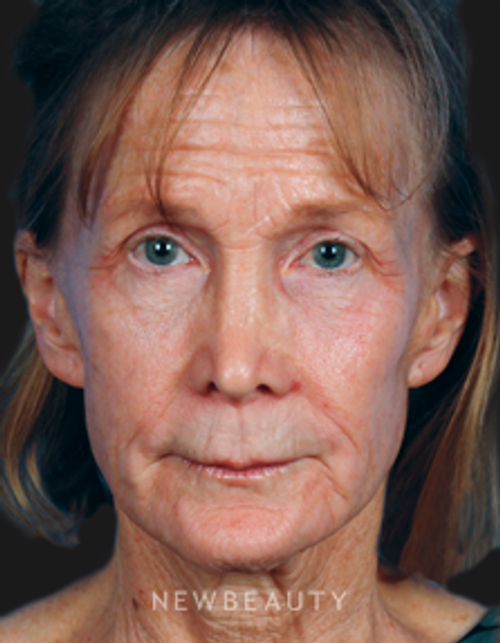 Dr. Kelly Bomer Liquid Lift, Lip Filler, Chemical Peel, Injectables & Fillers - Before