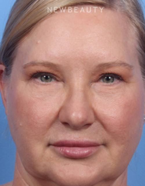 Dr. Kelly Bomer - Blepharoplasties - After