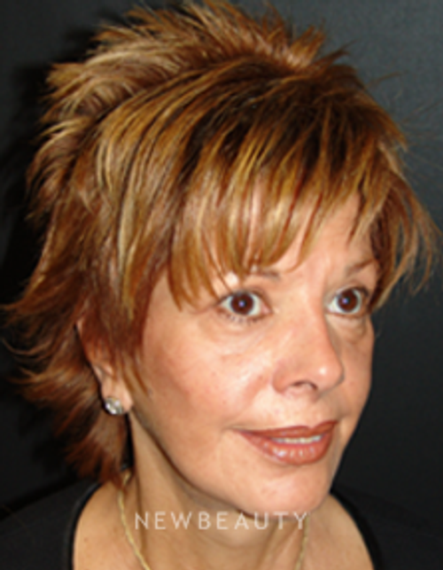 Dr. Mokhtar Asaadi Eyelid Lift, Facelift, Necklift - After