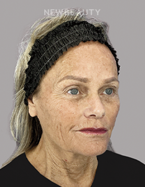 Dr. Sheila Barbarino-Laser-5479883 - Before