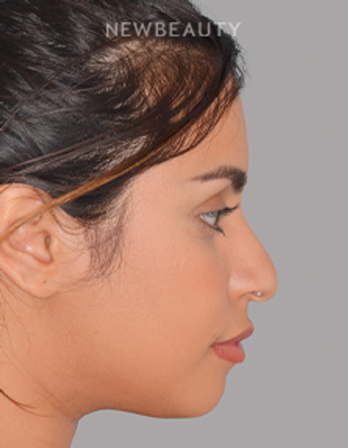 Dr. Anthony Bared - Refined Elegance - 44696946 - Before