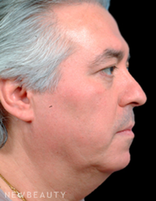 Dr. Steven Bloch Eyelid Lift, Chin Augmentation, Facelift - Before