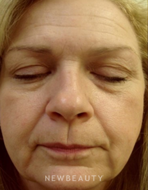 Dr. Doris Day - Botox - Before
