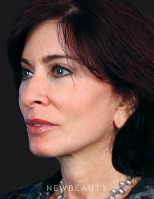 Dr. Kelly Bomer Injectables & Fillers, Liquid Lift - After