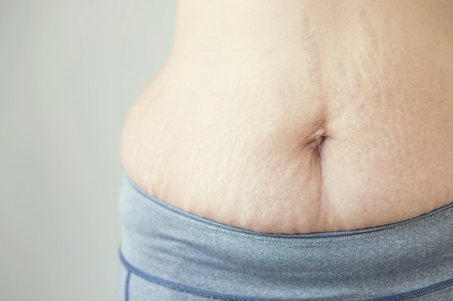 Your Mommy Makeover’s Nonsurgical Finishing Touch