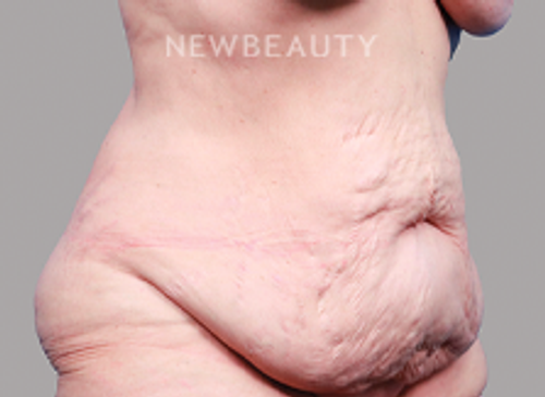 Dr. Michael Lofgren - Tummy Tuck After Weight Loss - 44688404 - Before