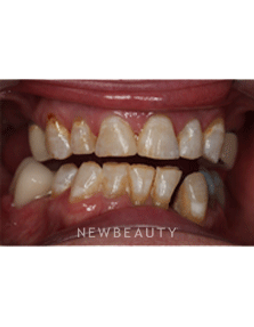 Dr. Neal Patel Smile Makeover - Before