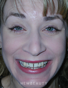 Dr Guy Lewis Crowns, Dental Implants, Gum Contouring - Before