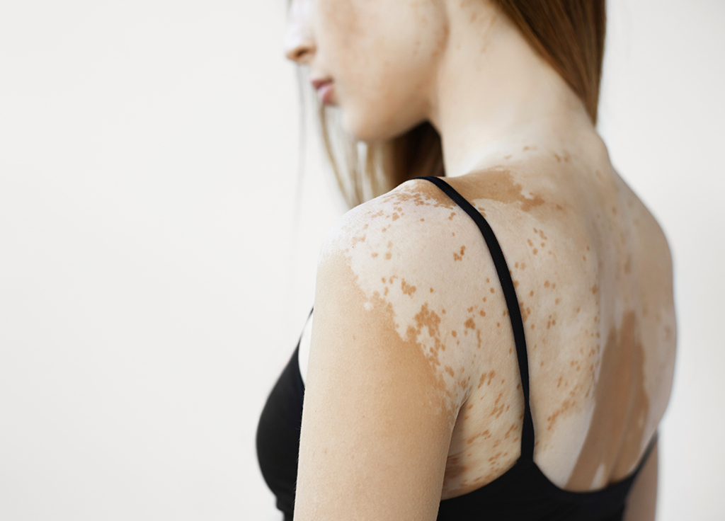 Today Is World Vitiligo Day—Here’s One Woman’s Personal Story About the Skin Condition