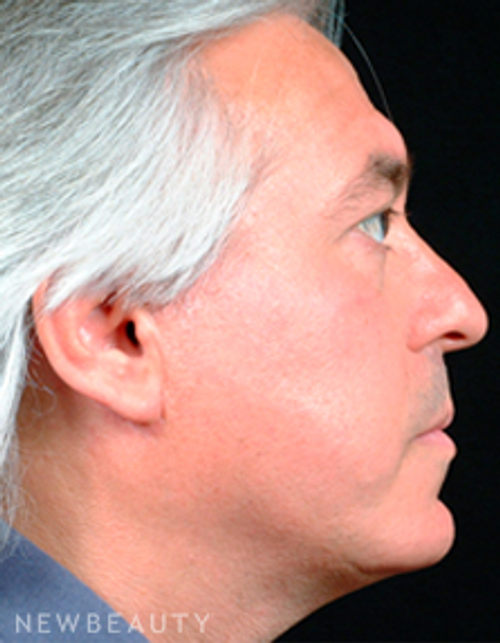 Dr. Steven Bloch Eyelid Lift, Chin Augmentation, Facelift - After