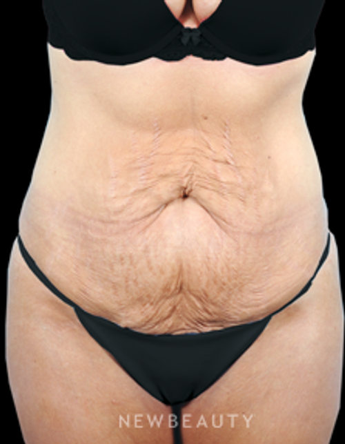 Dr. Bradley Bengtson - Tummy Tuck - Before