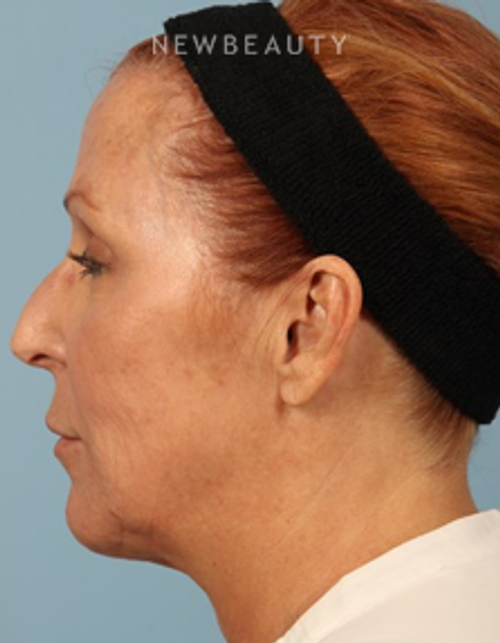 Dr. Carmen Kavali- Liquid Facelift - After