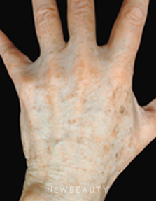 Dr. Jody Levine Lasers - Before