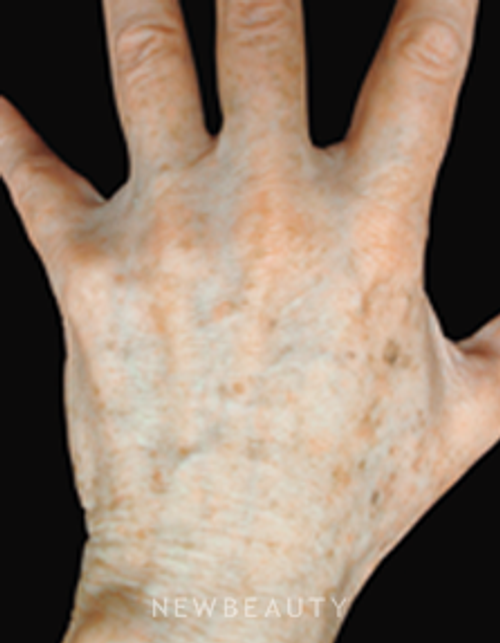 Dr. Jody Levine Lasers - Before