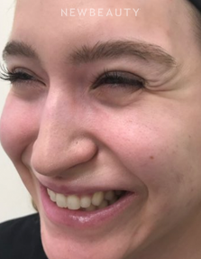 Dr. Julie Russak - Injectables & Fillers - Before