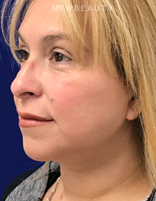 Dr. Dilip Madnani - Facelift & Necklift - After