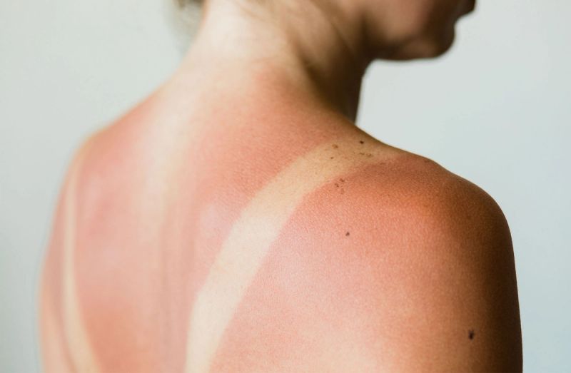 Never Put These Things on Your Sunburn, Doctors Warn