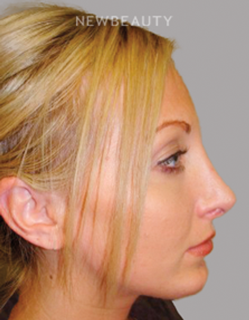 Dr. Sanjay Grover - Rhinoplasty - 49727904 - After
