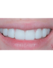 Dr. Guy Lewis Veneers - After
