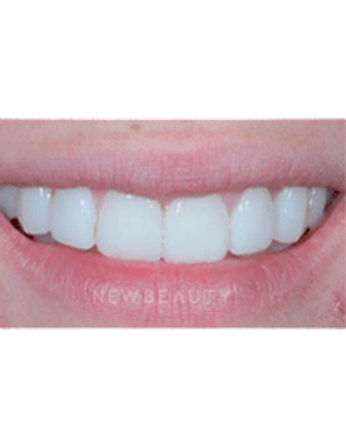 Dr. Guy Lewis Veneers - After