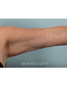 Dr. Kenneth Beer - CoolSculpting - After