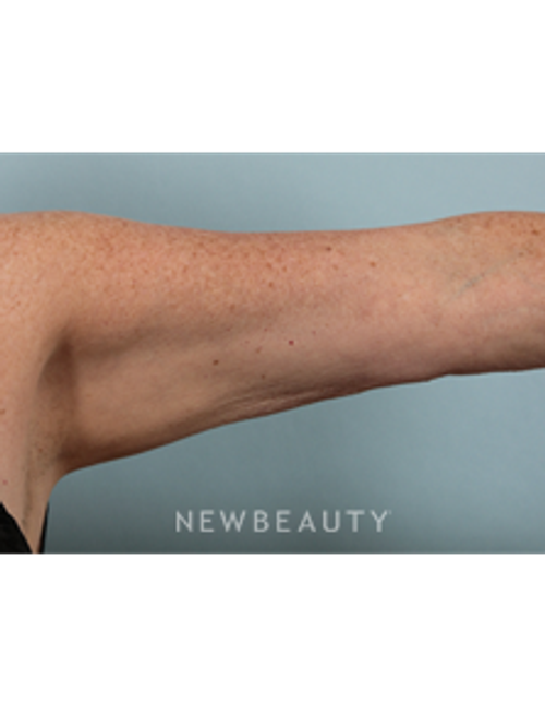 Dr. Kenneth Beer - CoolSculpting - After